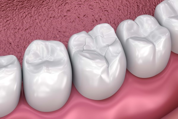 How A Dental Filling Can Protect Your Teeth