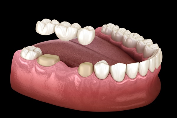 When Is A Dental Bridge Recommended To Replace Missing Teeth?