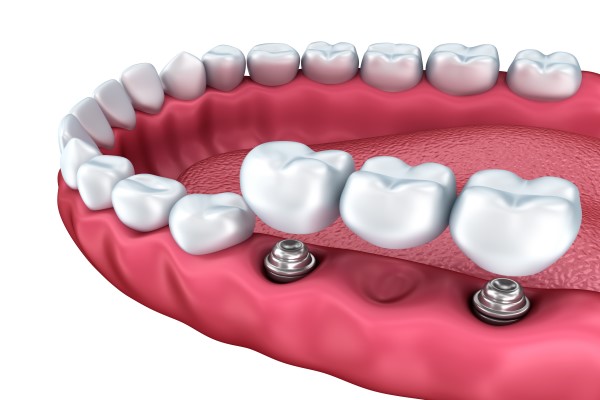 Are Dental Bridges Effective For Replacing Missing Teeth?