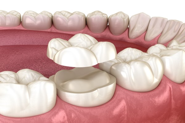 How Dental Crowns Are Bonded To A Tooth