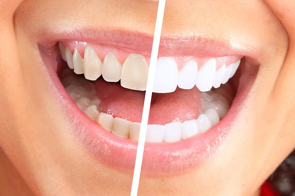 Can Teeth Whitening Products Be Used On Veneers?