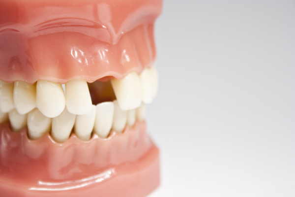 Why You Should Consider Tooth Replacement