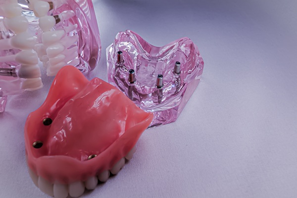 What Is The Best Tooth Replacement Option For Common Dental Issues?