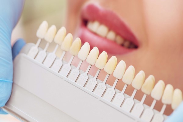 Understanding The Dental Veneers Process